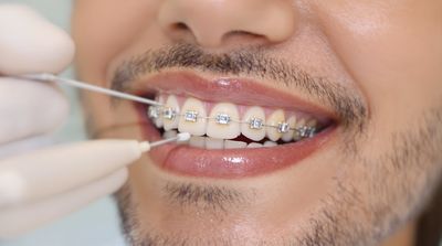 Close-up of ceramic clear braces blending naturally with patient's teeth